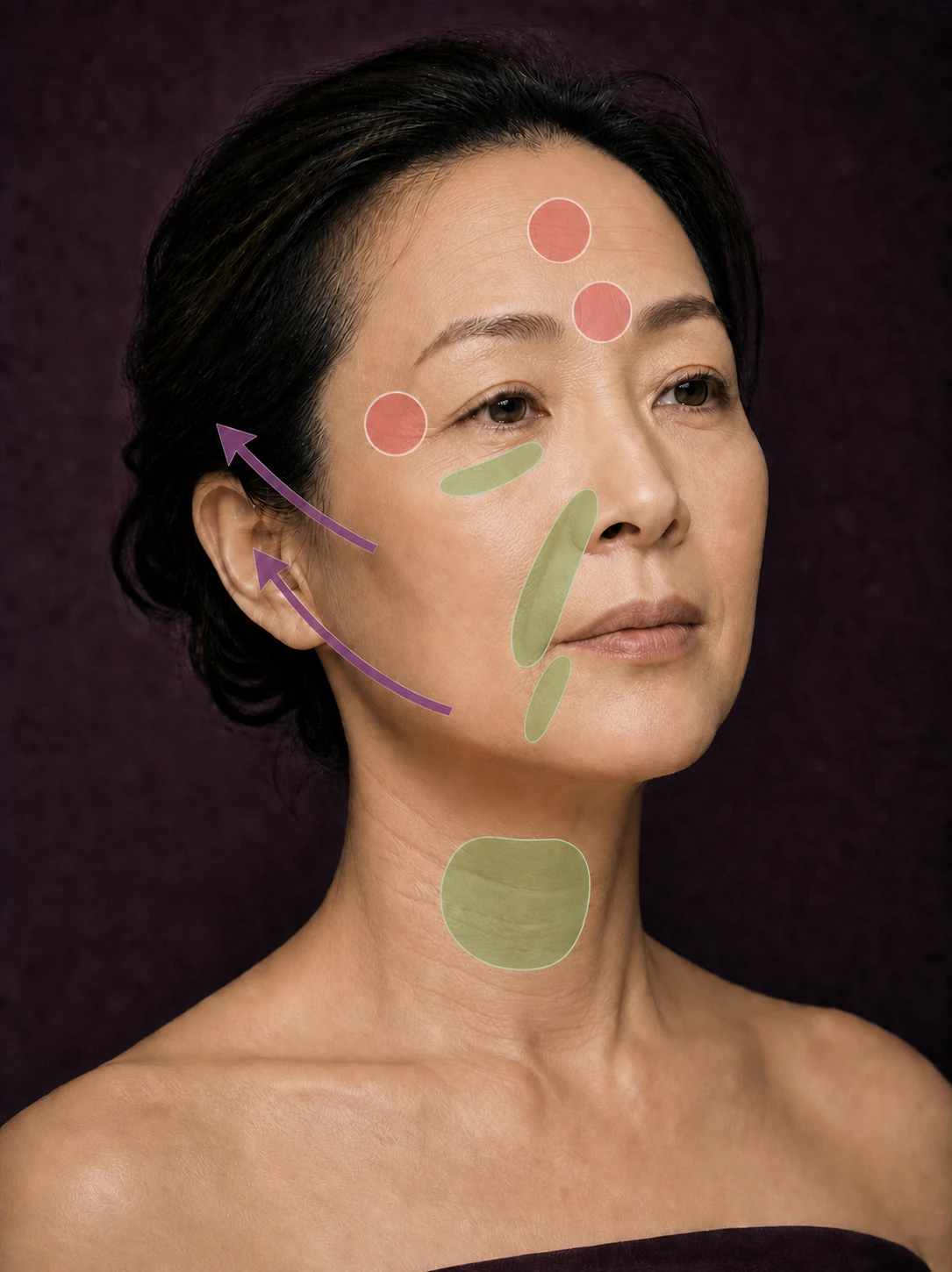 Even natural-skin three-quarter facial portrait with visible facial-aging lines, three rose Botox zones, four sage filler zones, and two aubergine PDO lifting arrows