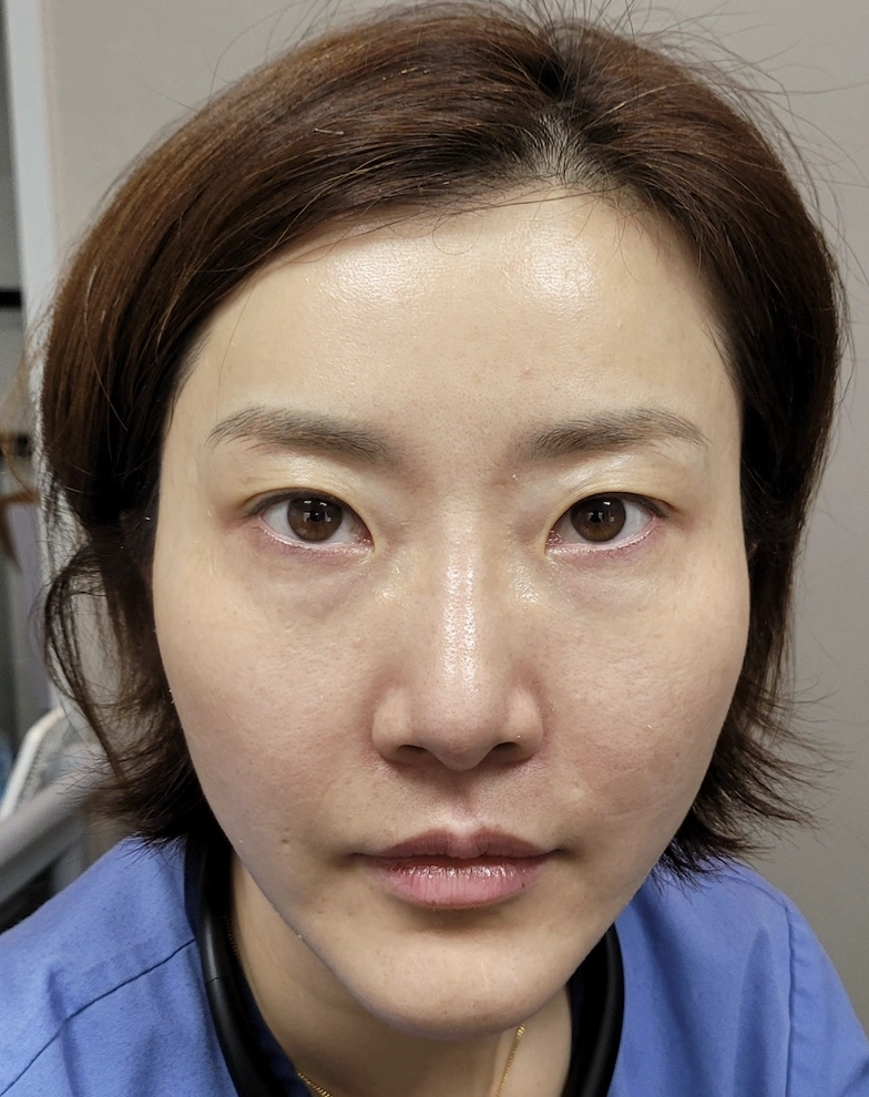 3D Facial Balance — After · 2 weeks